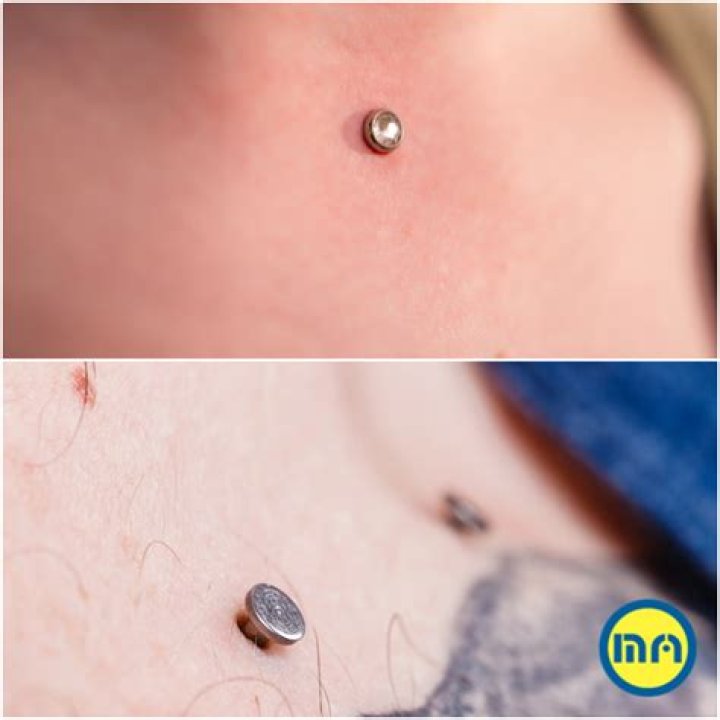 Are dermal anchors permanent