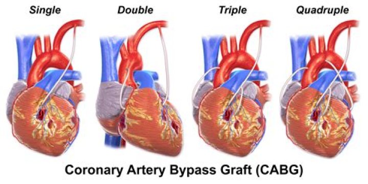 Are the CPT codes for a five vessel coronary artery bypass using two arteries and three vein grafts