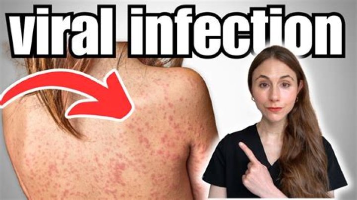 Are Viral hives itchy