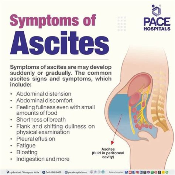 At what stage does ascites occur