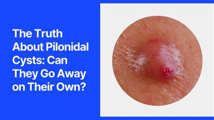 Can a child get a pilonidal cyst