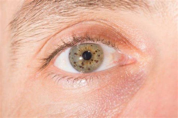 Can a freckle be raised
