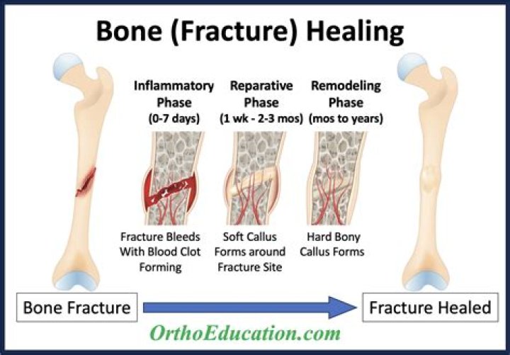 Can a toddler fracture heal on its own