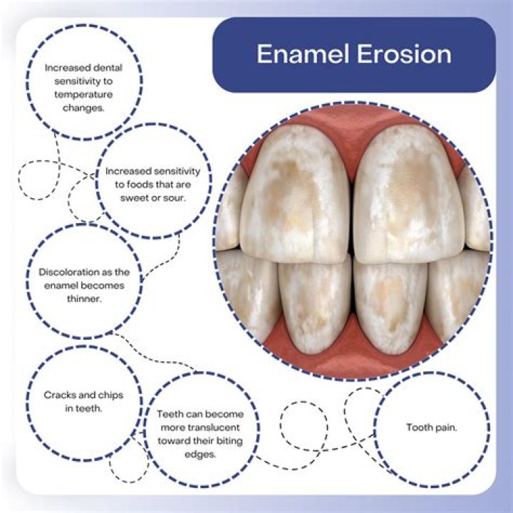 Can activated charcoal damage enamel
