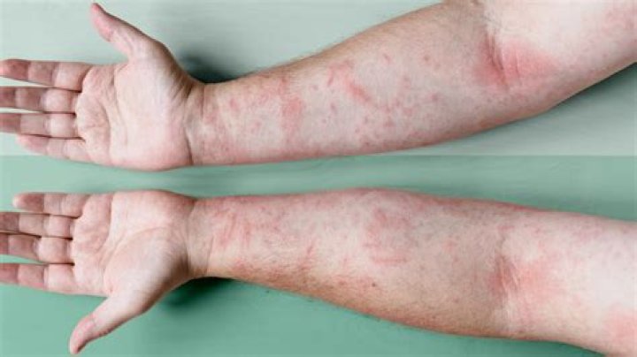 Can agave cause allergies