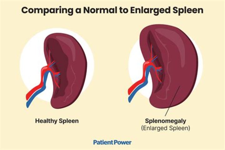 Can an enlarged spleen be normal