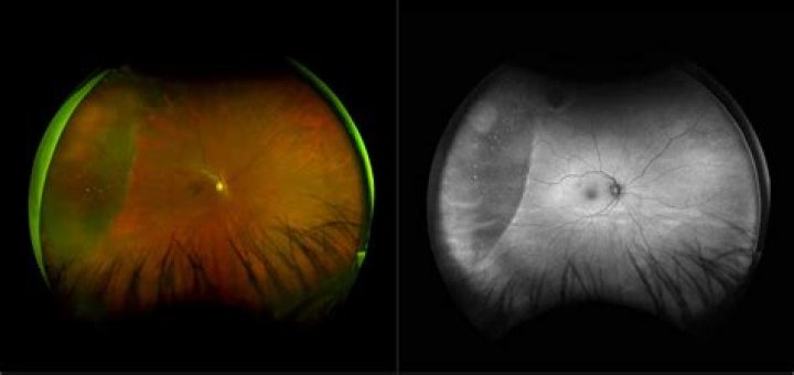 Can an optometrist diagnose a retinal tear