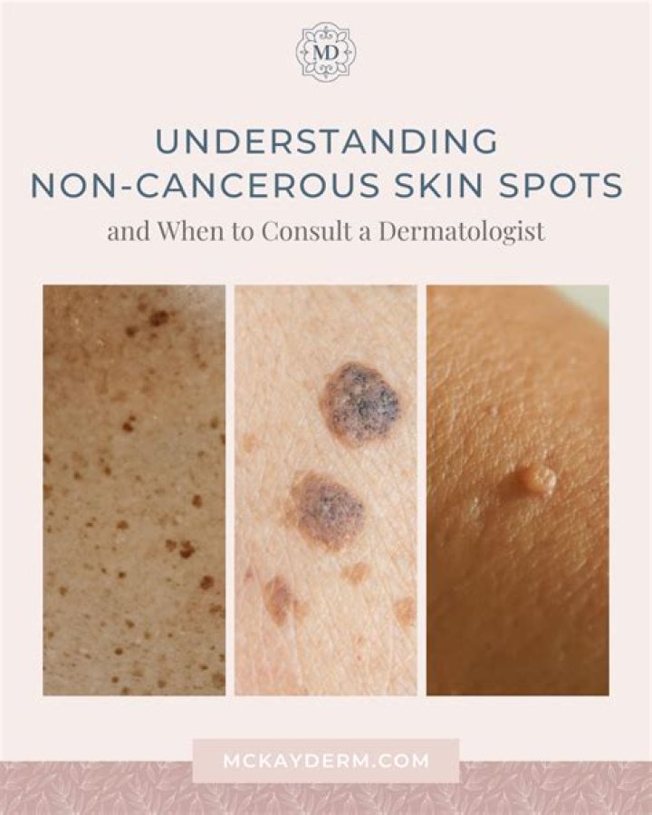 Can benign skin growths bleed