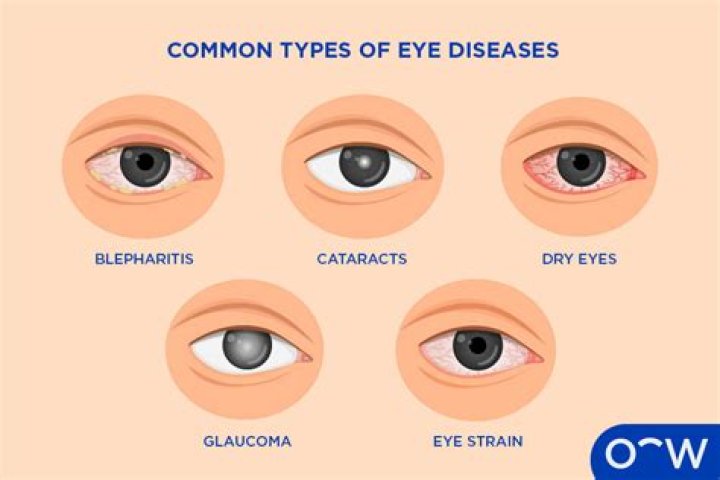 Can hemochromatosis cause eye problems