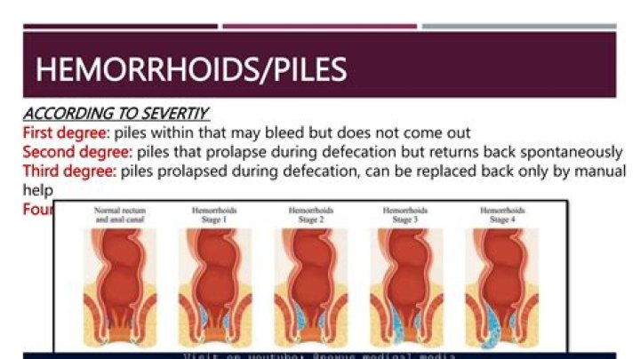 Can internal hemorrhoids cause thin stools