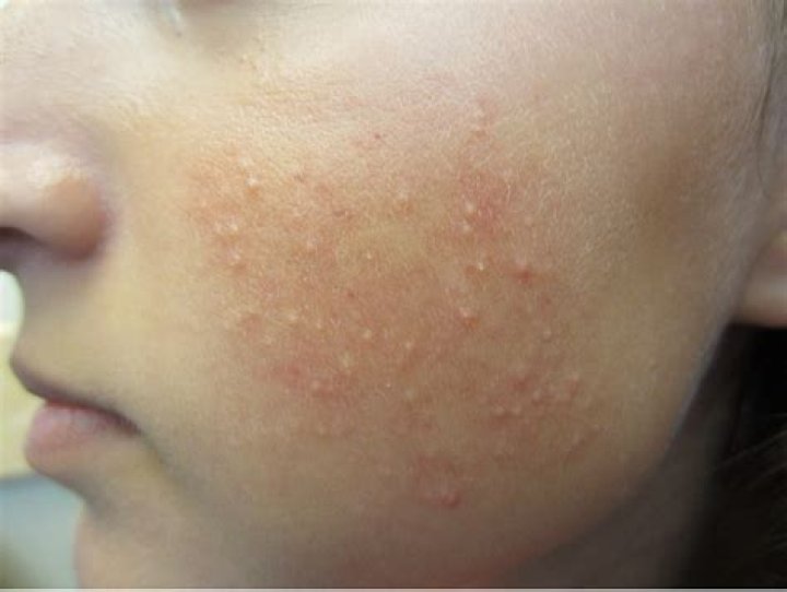 Can keratosis pilaris cause acne