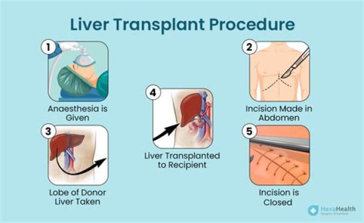 Can liver transplant