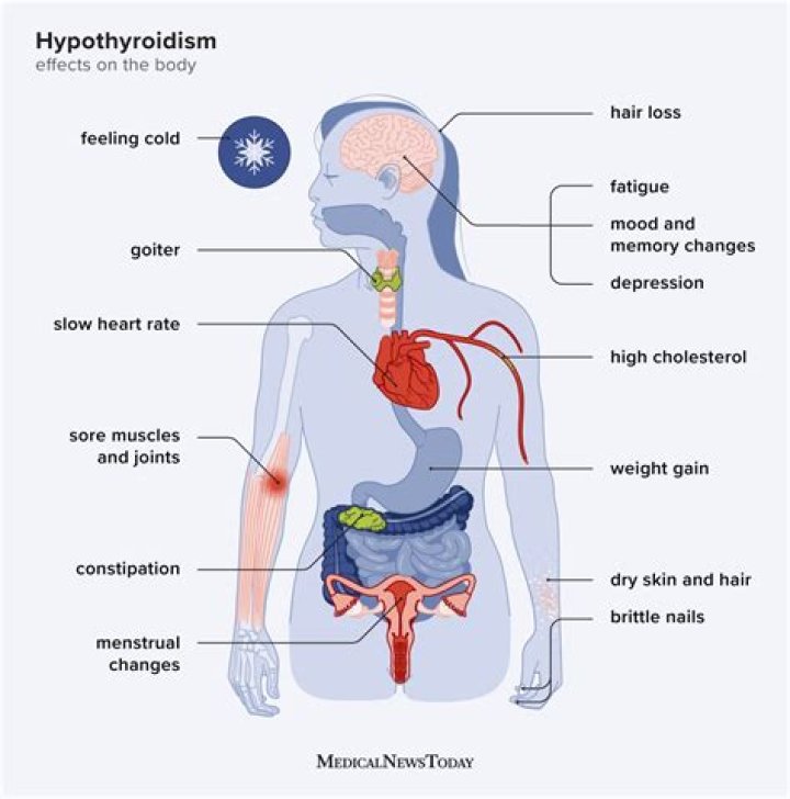 Can low iodine cause hypothyroidism
