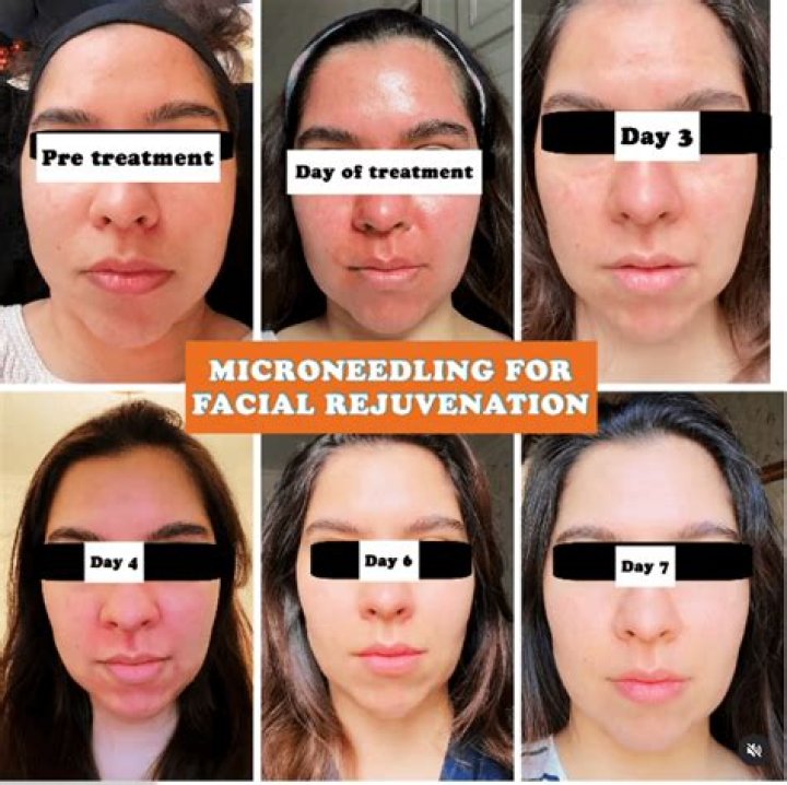 Can microneedling be done by an esthetician