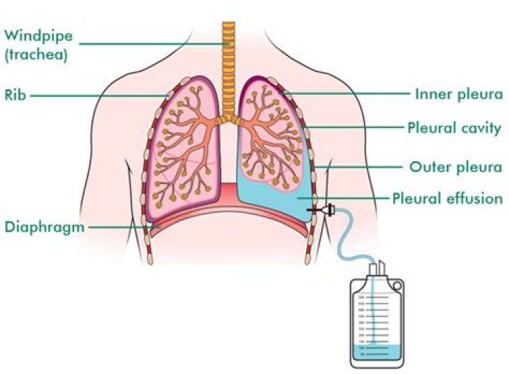 Can pleural effusion clear up on its own
