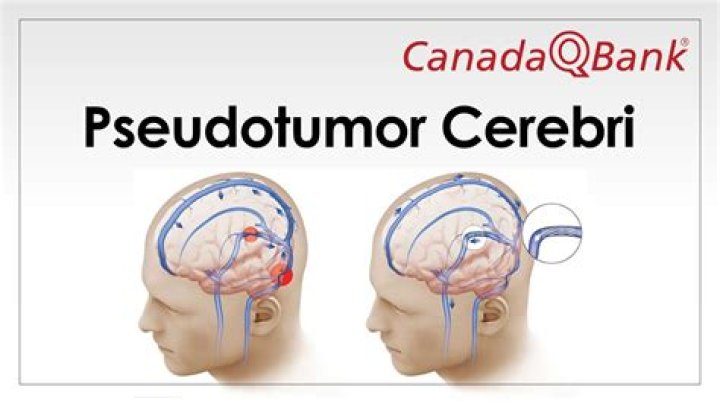 Can pseudotumor cerebri be cured