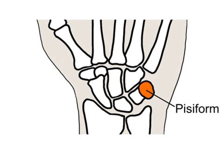 Can the pisiform bone be removed