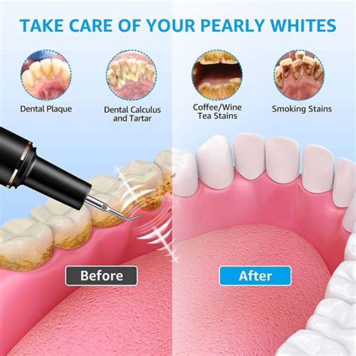 Can you clean your teeth with denture cleaner