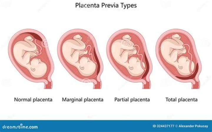 Can you do anything to help placenta previa