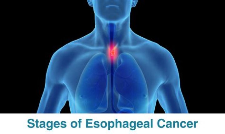 Can you eat with esophageal varices