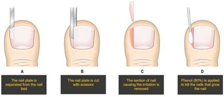 Can you remove a fingernail