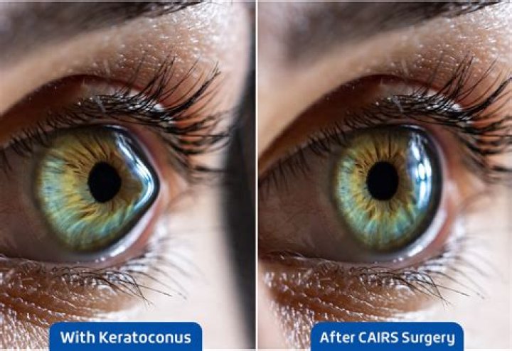 Can you see keratoconus