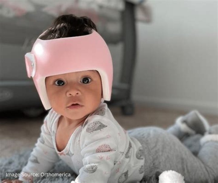 Do doctors mold babies heads