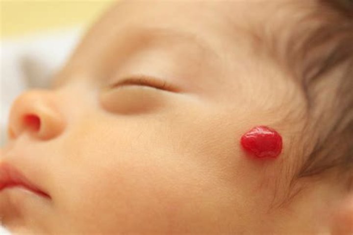 Do liver hemangiomas go away on their own