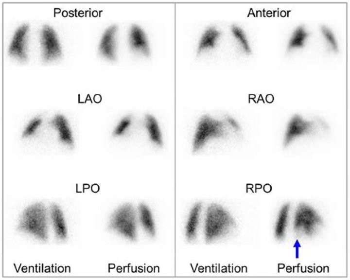 Do you have to be NPO for a VQ scan
