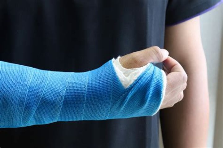 Do you need a cast for a buckle fracture