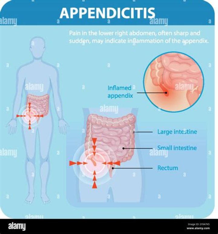 Does appendicitis feel like a pulled muscle