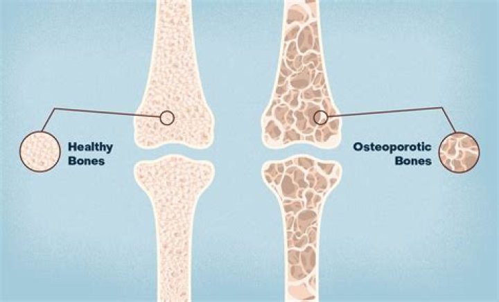 Does Blythe Danner have osteoporosis