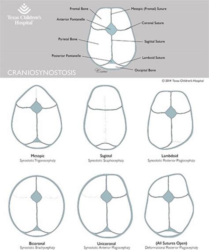 Does craniosynostosis run in families