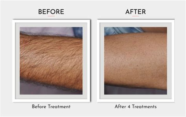 Does hair grow back thicker after Dermaflash
