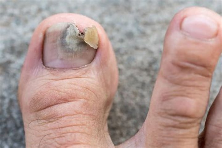 Does toenail fungus turn black