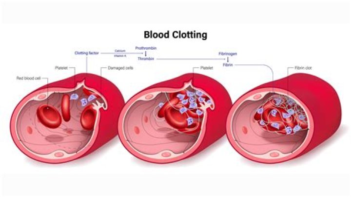 Does walking help prevent blood clots