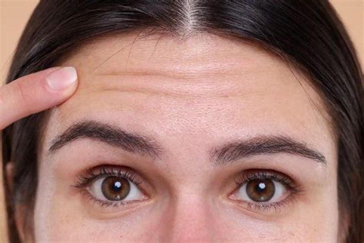 How can I get rid of forehead wrinkles naturally