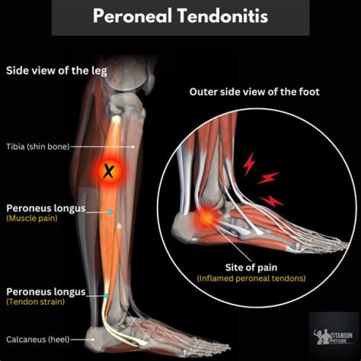 How can I treat tendonitis at home