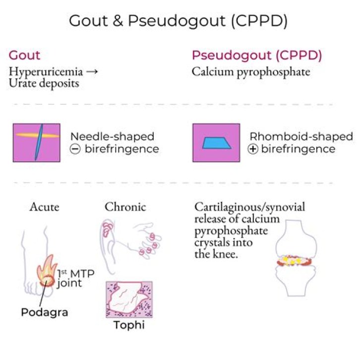 How can you tell the difference between gout and pseudogout