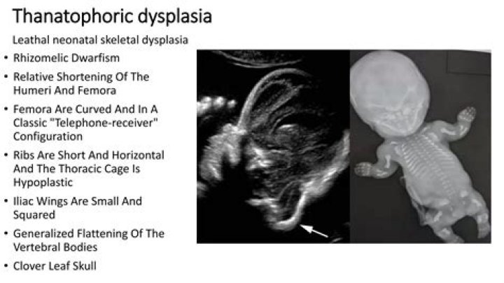 How common is Thanatophoric dysplasia