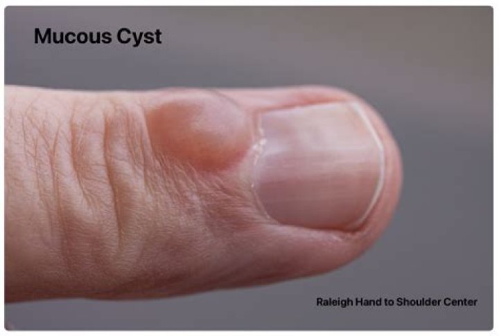 How do I get rid of a mucous cyst in my mouth