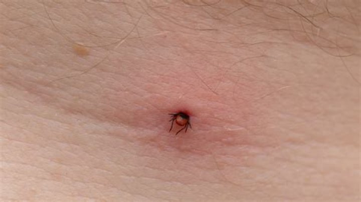 How do I know if a tick bit me