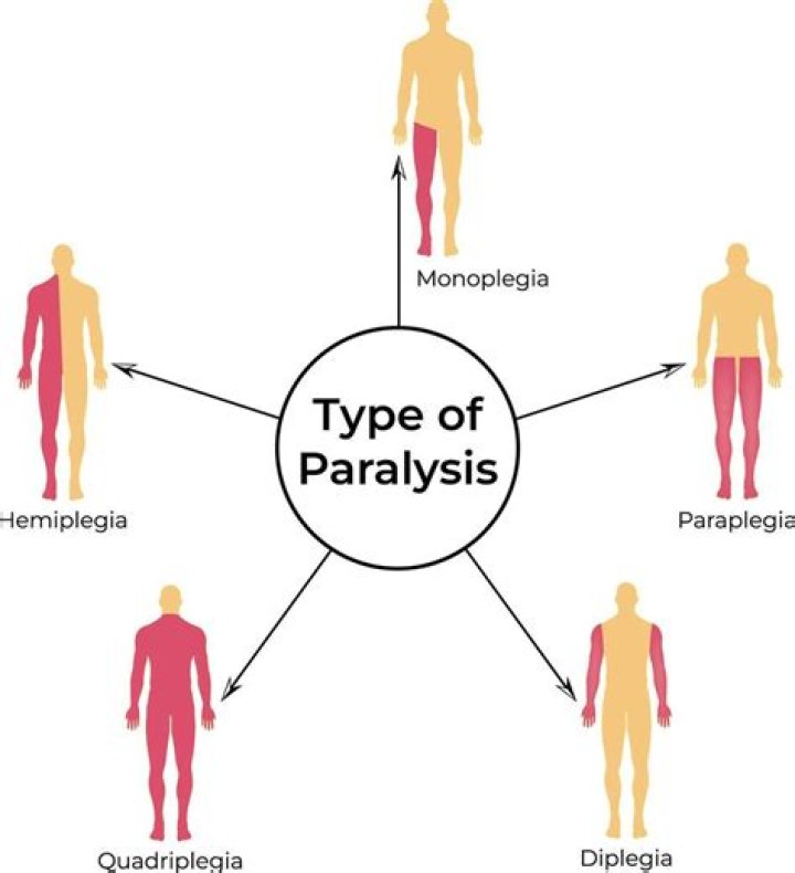 How do the conditions paraplegia hemiplegia and quadriplegia differ