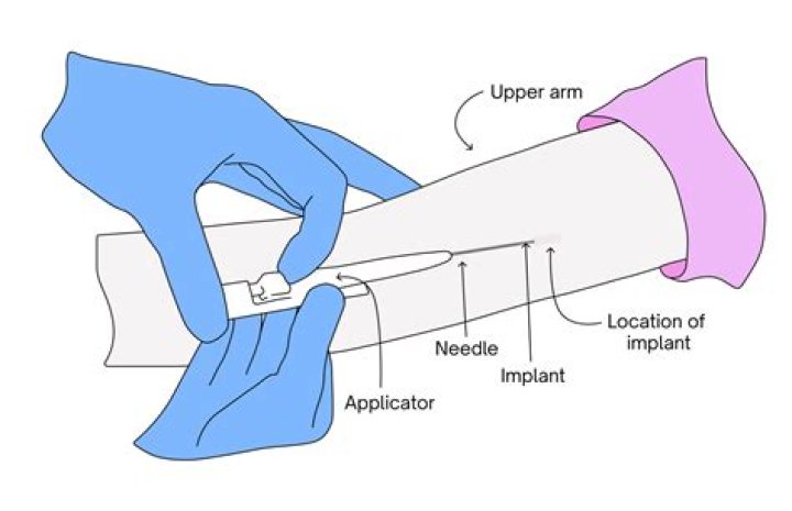 How do they put the birth control implant in your arm