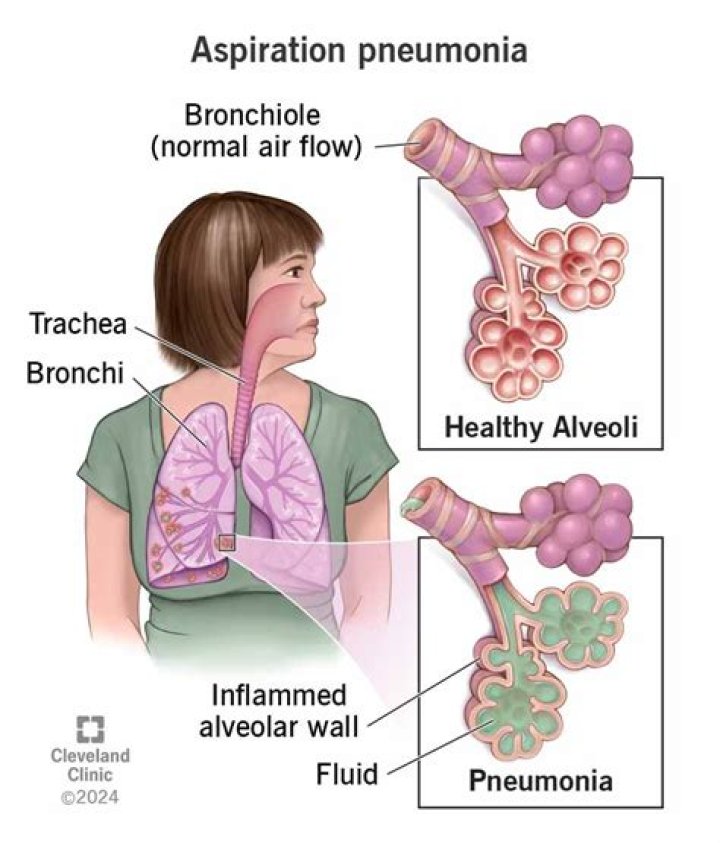 How do you code aspiration pneumonia