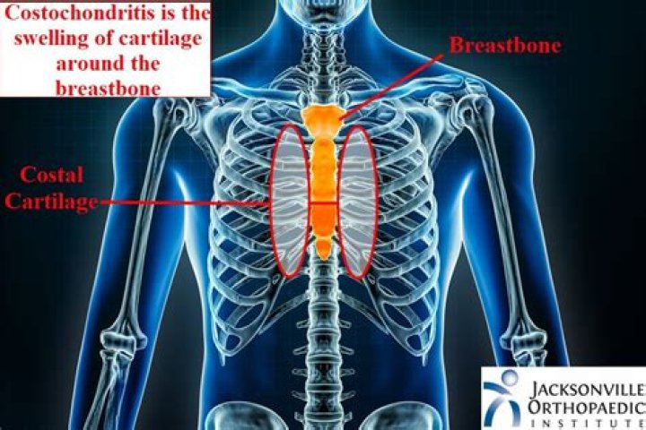 How do you cure Costochondral separation
