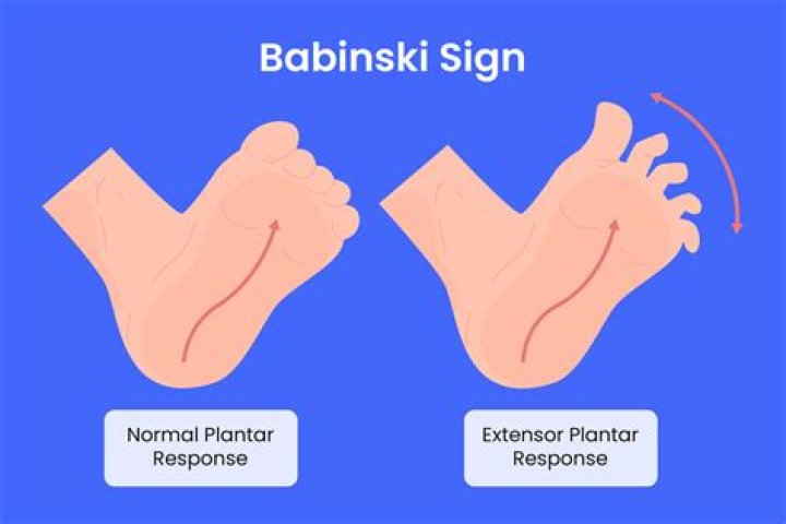 How do you do the Babinski test