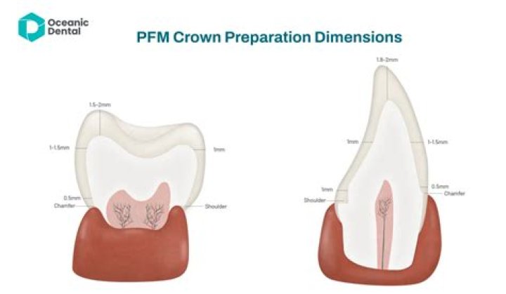 How do you find the occlusal vertical dimension