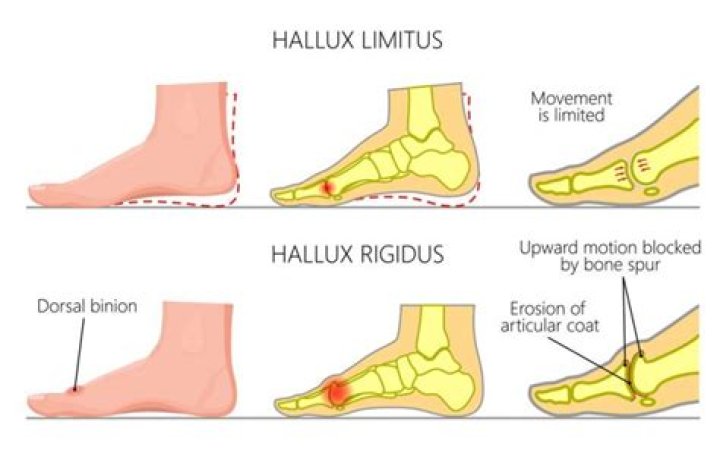 How do you fix hallux valgus