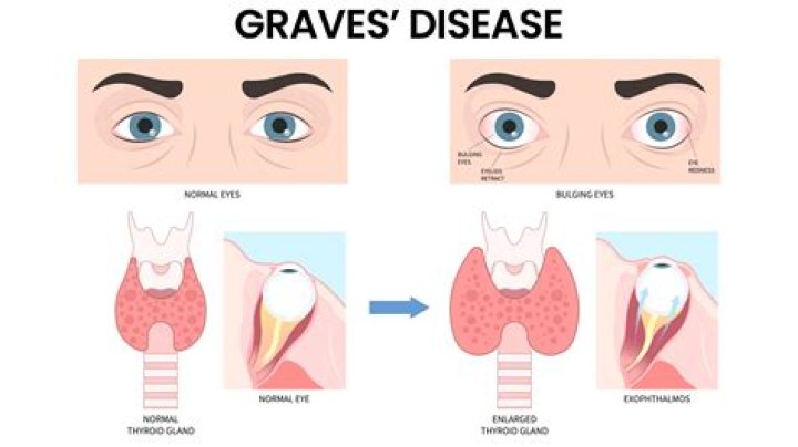 How do you get Graves disease